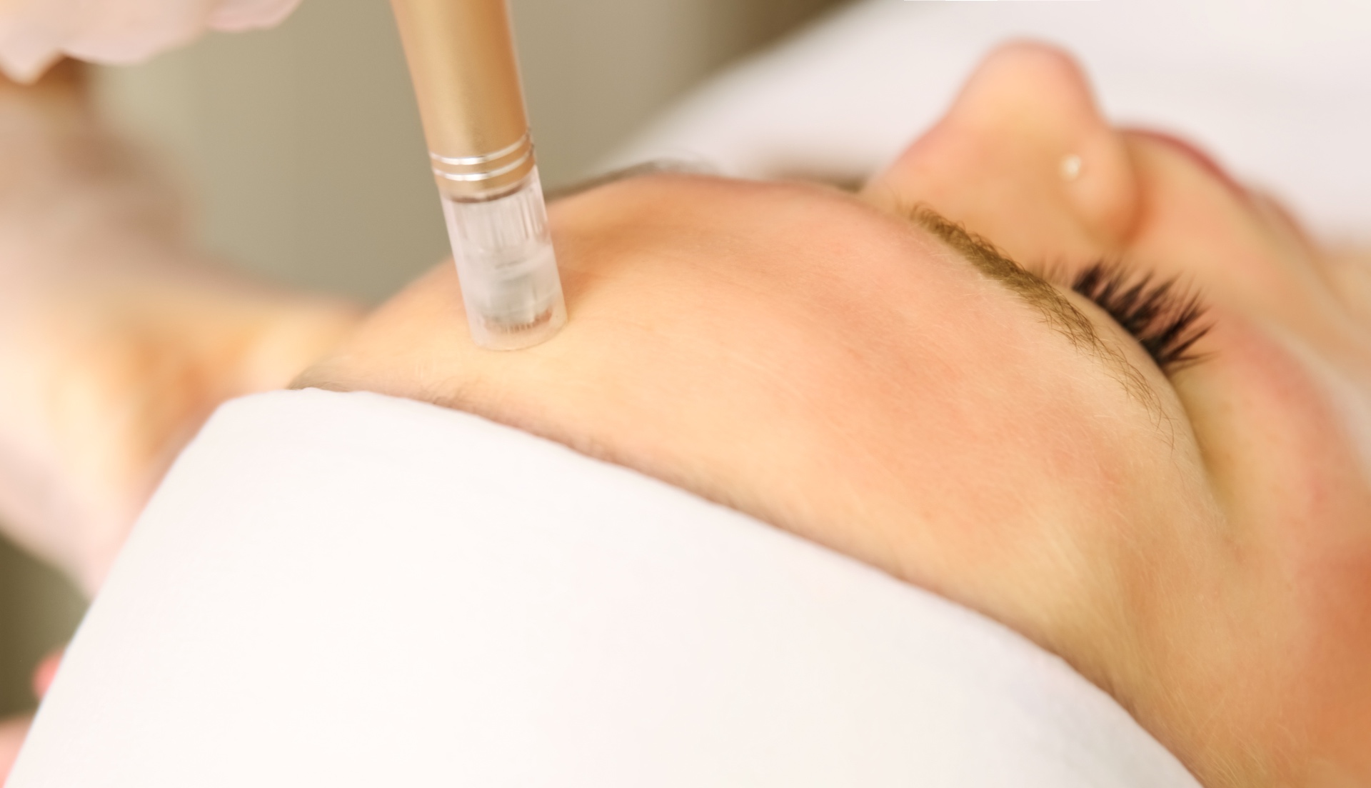 Microneedling behandling